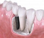 Dental Implants Barrington IL